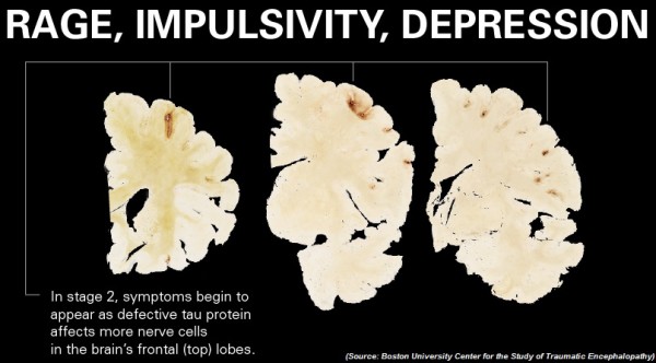 CTE-NFL-Concussions-Brain-Tissue | www.4hourbodygirl.com